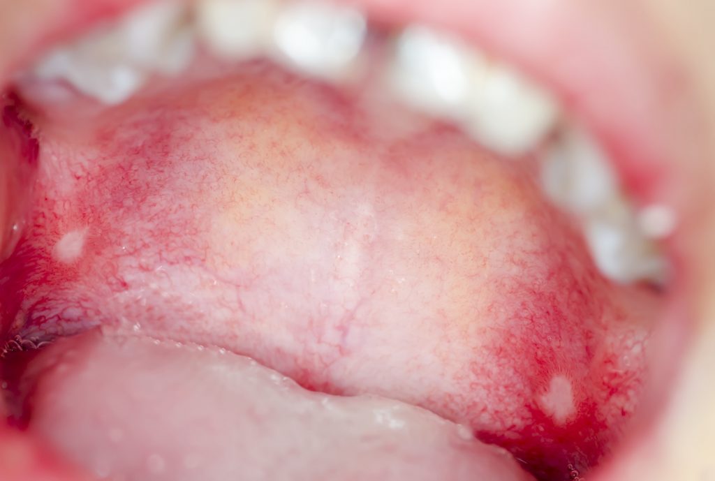 Causes Of Bumps On Roof Of Mouth Canker Sores 1024x689 