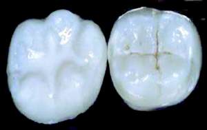 dentist-fairfield-dental-sealants