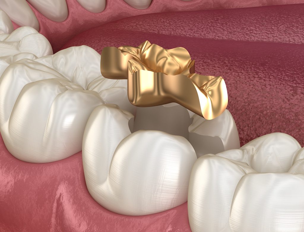 gold fillings dentist fairfield ca