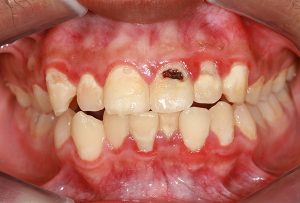 gum-disease-oral-cancer-risk-link